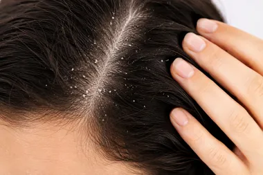 Close-up of scalp with visible white flakes along the hair part