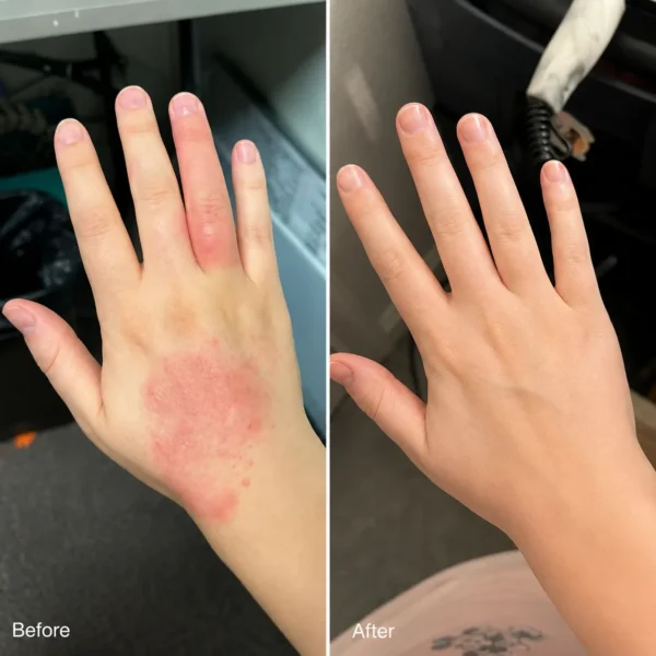 Before and after comparison of hand dermatitis showing reduced redness after treatment