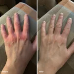 Side-by-side before and after results on hand skin affected by dermatitis